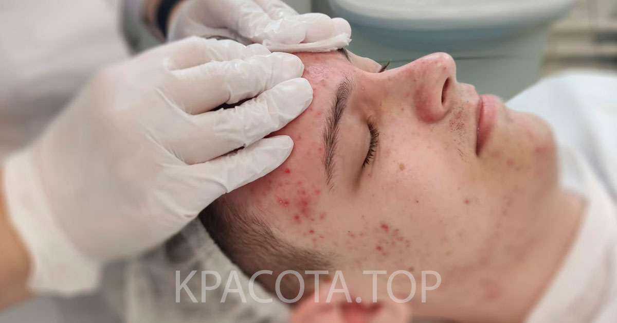 Причины акне