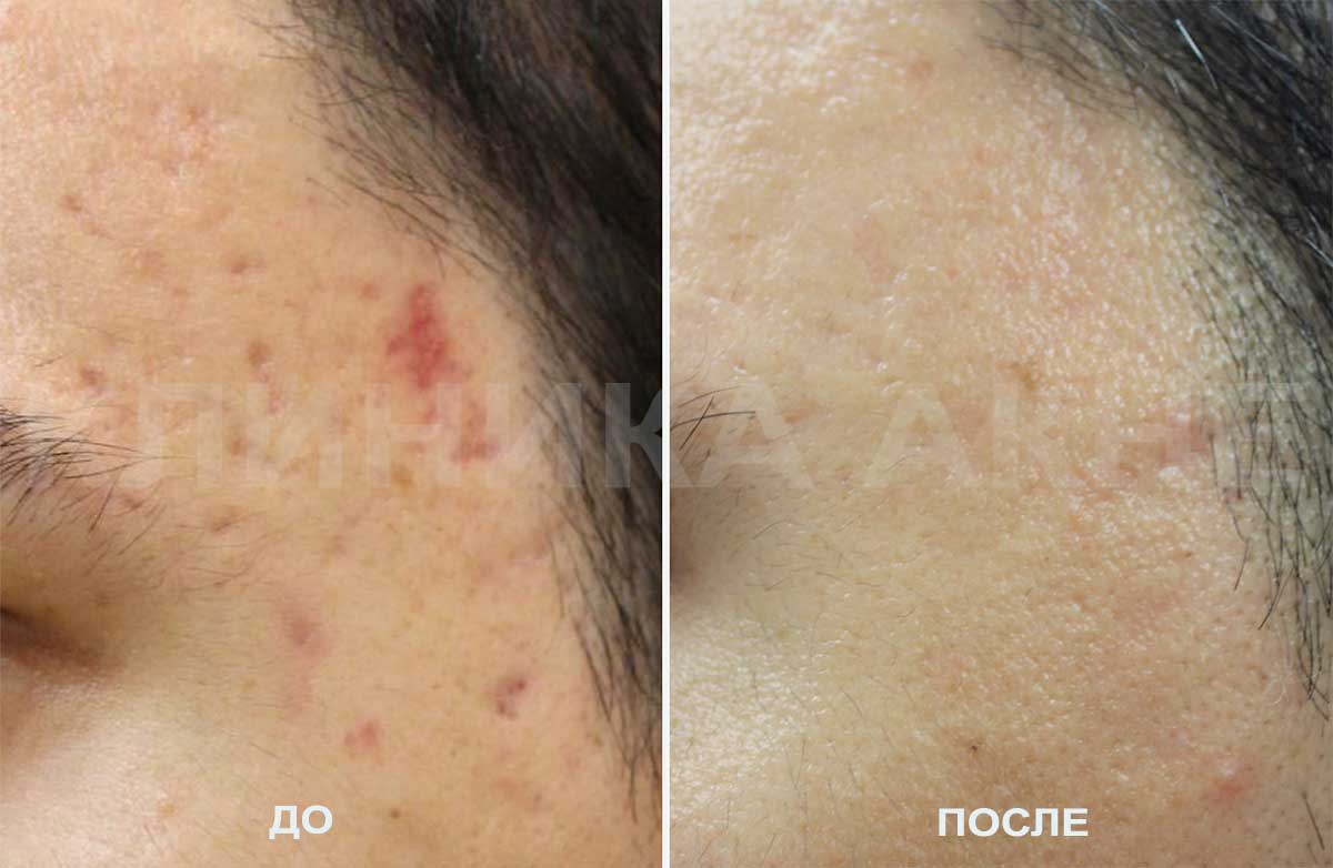 Удаление акне