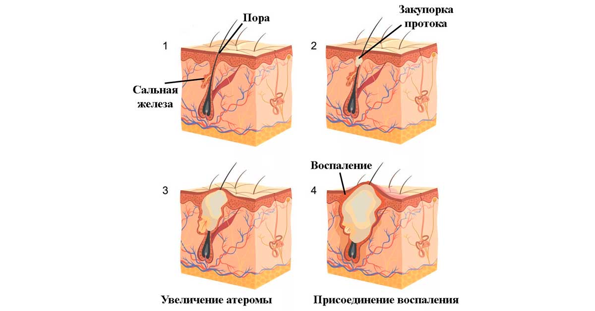 Степени акне