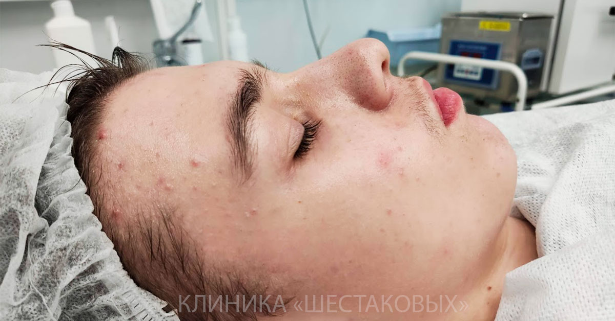 Некоторые Средства И Препараты Для Лечения Акне Подростков
