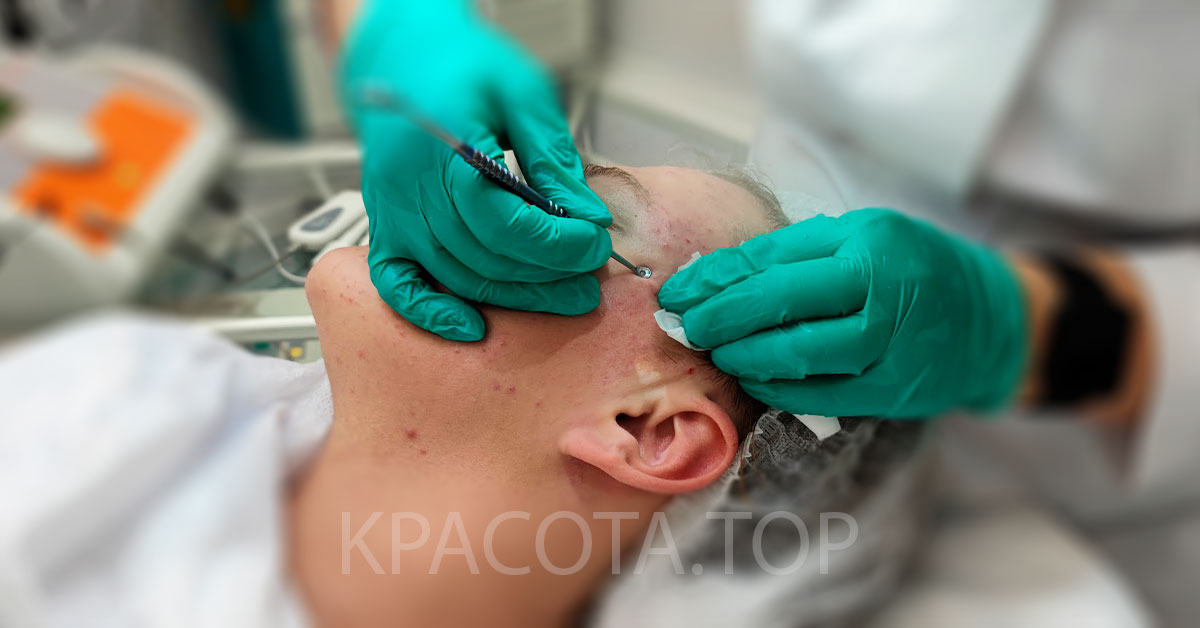 Угревая сыпь