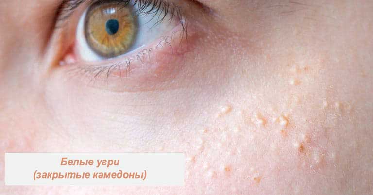 Типы прыщей