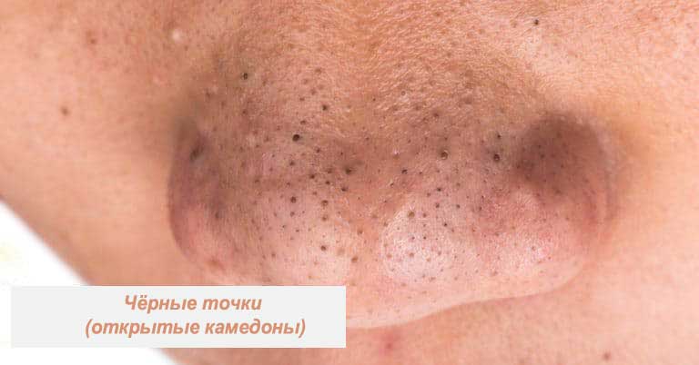 Типы прыщей