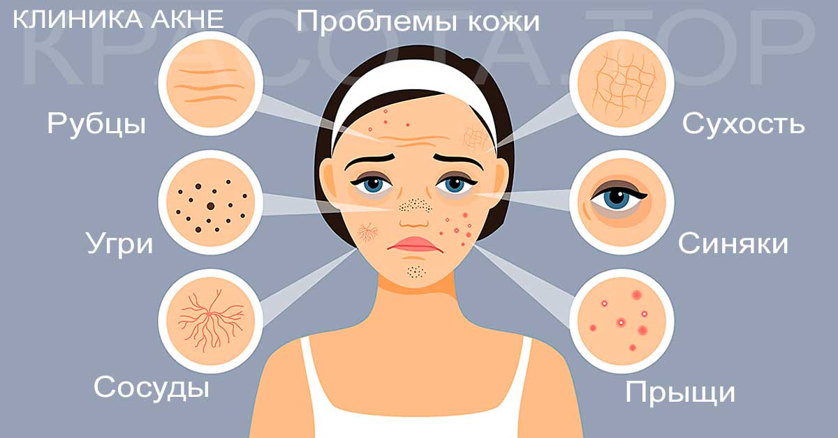Что такое акне