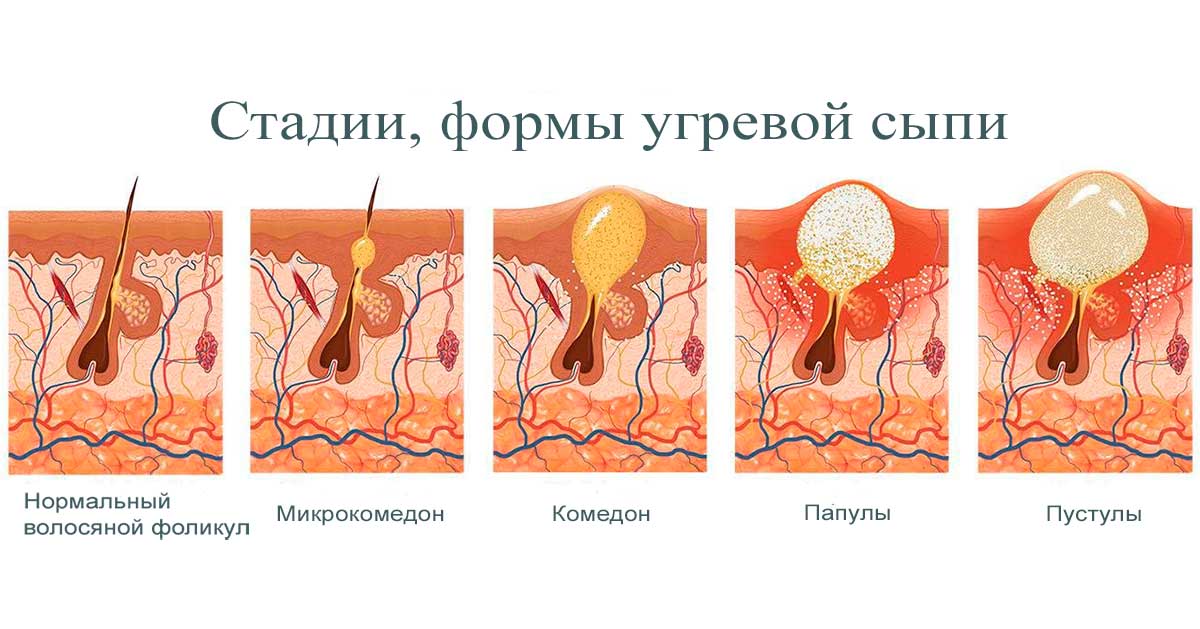 Тяжёлое акне