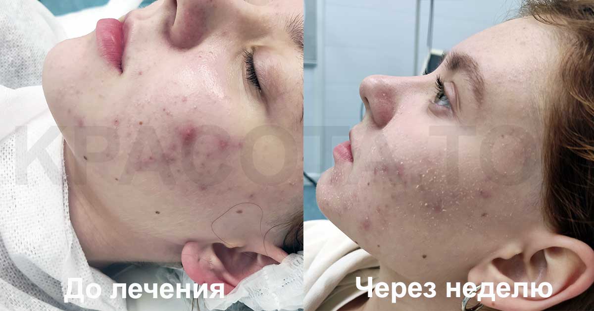Акне комедоны