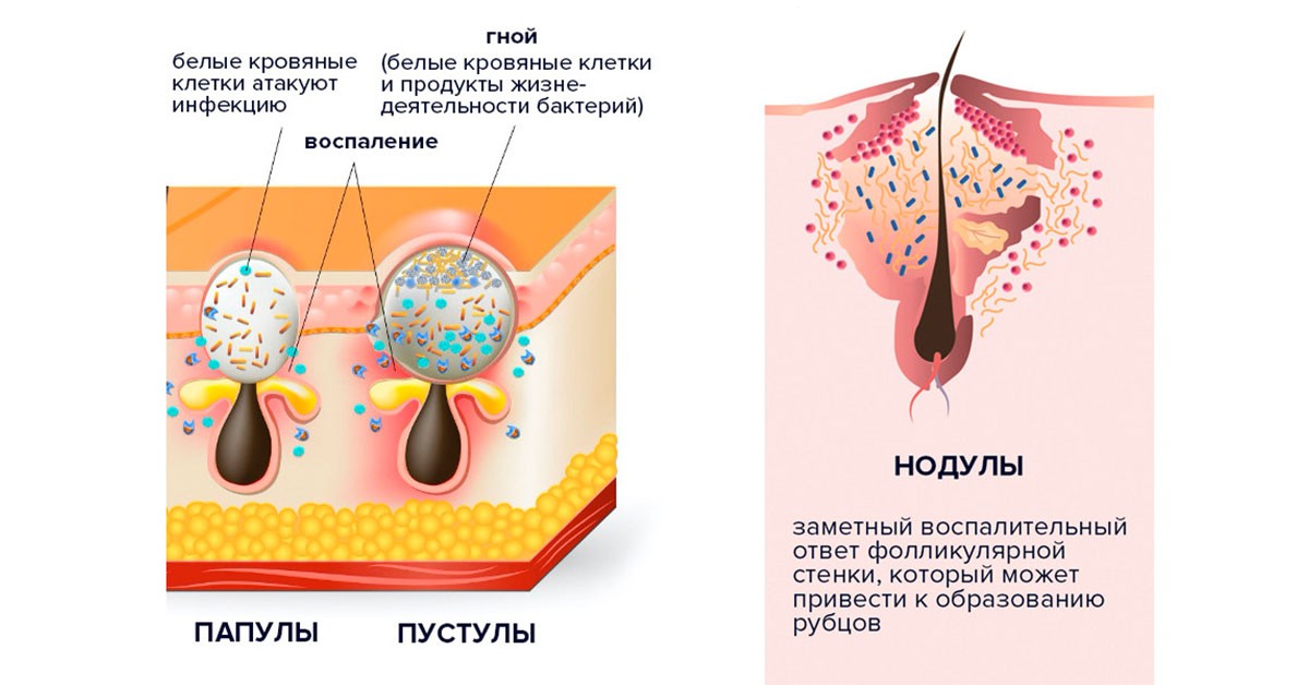 Акне средней степени тяжести