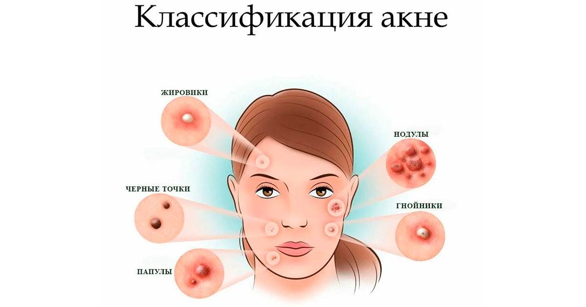 Угорь прыщ