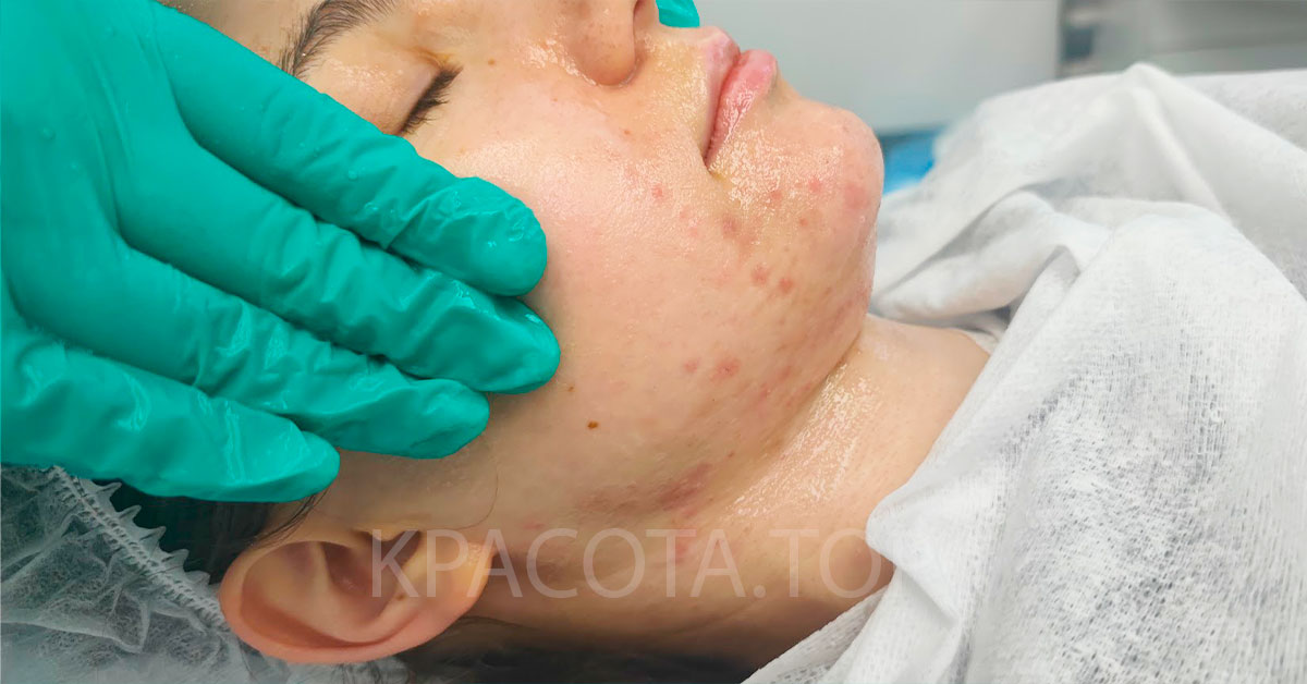 Процедура анти акне